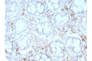 Formalin-fixed, paraffin-embedded human Colon Carcinoma stained with CD209 Mouse Monoclonal Antibody (rC209/1781). (Recombinant DC-SIGN/CD209 antibody)