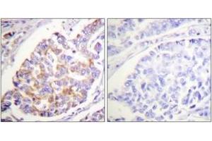 Immunohistochemistry analysis of paraffin-embedded human breast carcinoma, using ADD1 (Phospho-Ser726) Antibody. (alpha Adducin antibody  (pSer726))