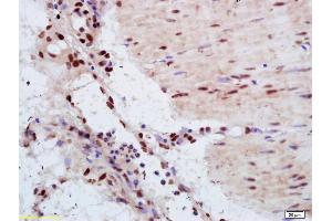 Formalin-fixed and paraffin embedded human gastric carcinoma labeled with Anti-YAP1 Polyclonal Antibody, Unconjugated (ABIN701485) at 1:200 followed by conjugation to the secondary antibody and DAB staining. (YAP1 antibody  (AA 131-330))