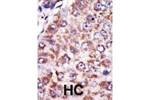 Formalin-fixed and paraffin-embedded human cancer tissue reacted with the primary antibody, which was peroxidase-conjugated to the secondary antibody, followed by DAB staining. (FDFT1 antibody  (N-Term))