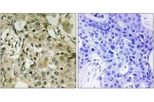 Immunohistochemistry analysis of paraffin-embedded human breast carcinoma tissue, using DTYMK Antibody. (DTYMK antibody  (AA 1-50))