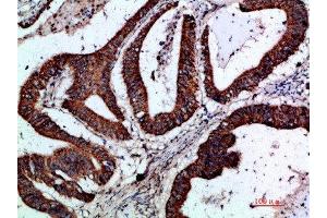 Immunohistochemical analysis of paraffin-embedded human-colon-cancer, antibody was diluted at 1:200 (GREM2 antibody  (AA 71-120))