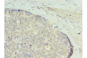 Immunohistochemistry of paraffin-embedded human gastric cancer using ABIN7166707 at dilution of 1:100 (GTPBP6 antibody  (AA 146-295))