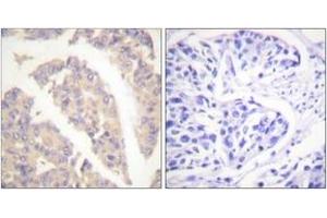 Immunohistochemistry analysis of paraffin-embedded human breast carcinoma tissue, using CBL (Ab-700) Antibody. (CBL antibody  (AA 666-715))