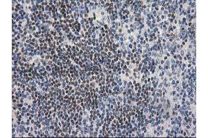 Immunohistochemical staining of paraffin-embedded Human lymphoma tissue using anti-ARFGAP1 mouse monoclonal antibody. (ARFGAP1 antibody)