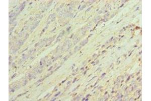 Immunohistochemistry of paraffin-embedded human colon cancer using ABIN7143694 at dilution of 1:100 (AKR1C3 antibody  (AA 1-323))