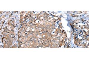 Immunohistochemistry of paraffin-embedded Human breast cancer tissue using WFDC5 Polyclonal Antibody at dilution of 1:60(x200)