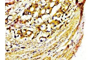 IHC image of ABIN7155047 diluted at 1:400 and staining in paraffin-embedded human gastric cancer performed on a Leica BondTM system. (MST1 antibody  (AA 363-465))