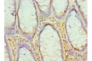 Immunohistochemistry of paraffin-embedded human colon cancer using ABIN7163806 at dilution of 1:100 (EED antibody  (AA 1-300))