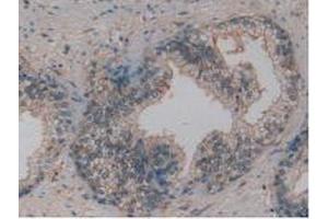 IHC-P analysis of Human Prostate Gland Cancer Tissue, with DAB staining. (Osteopontin antibody  (AA 17-287))
