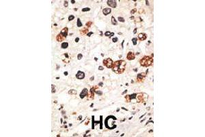 Formalin-fixed and paraffin-embedded human hepatocellular carcinoma tissue reacted with GJB3 polyclonal antibody  , which was peroxidase-conjugated to the secondary antibody, followed by DAB staining. (Connexin 31 antibody  (C-Term))
