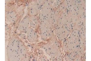 Detection of COL6a3 in Human Esophagus cancer Tissue using Polyclonal Antibody to Collagen Type VI Alpha 3 (COL6a3)