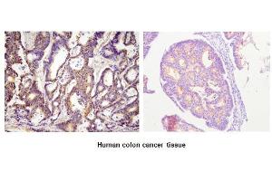 Paraffin embedded sections of human colon canitrocelluloseer tissue were initrocelluloseubated with anti-human ACOT11 (1:100) for 2 hours at room temperature. (ACOT11 antibody  (AA 19-250))