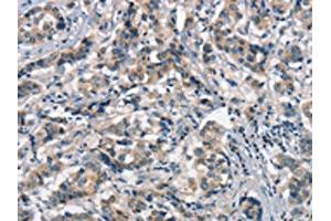 The image on the left is immunohistochemistry of paraffin-embedded Human breast cancer tissue using ABIN7189845(APOA1BP Antibody) at dilution 1/15, on the right is treated with synthetic peptide. (APOA1BP antibody)