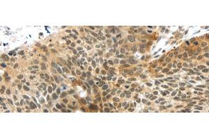 Immunohistochemistry of paraffin-embedded Human esophagus cancer tissue using TTBK2 Polyclonal Antibody at dilution 1:45 (TTBK2 antibody)