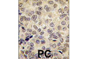 Formalin-fixed and paraffin-embedded human prostate carcinoma tissue reacted with DNMT3B polyclonal antibody  , which was peroxidase-conjugated to the secondary antibody, followed by DAB staining. (DNMT3B antibody  (Internal Region))