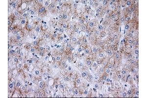 Immunohistochemical staining of paraffin-embedded Carcinoma of Human liver tissue using anti-RAB17 mouse monoclonal antibody. (RAB17 antibody)