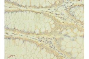 Immunohistochemistry of paraffin-embedded human colon cancer using ABIN7163708 at dilution of 1:100