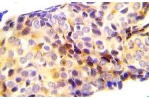 Immunohistochemistry (IHC) analyz es of p-beta-catenin (pThr41/pSer45) antibody in paraffin-embedded human plung adenocarcinoma tissue.