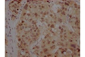 IHC image of ABIN7127369 diluted at 1:100 and staining in paraffin-embedded human liver cancer performed on a Leica BondTM system. (Recombinant BMI1 antibody)