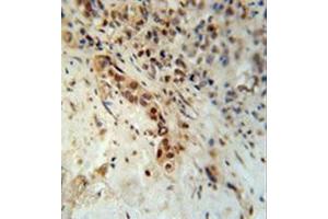 Formalin fixed, paraffin embedded human lung carcinoma stained with Artemis Antibody (N-term) followed by peroxidase conjugation of the secondary antibody and DAB staining. (DCLRE1C antibody  (N-Term))