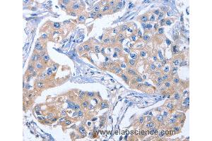 Immunohistochemistry of Human colon cancer using IBSP Polyclonal Antibody at dilution of 1:50 (IBSP antibody)