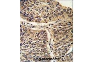 Formalin-fixed and paraffin-embedded human lung carcinoma reacted with CCT3 Antibody (C-term), which was peroxidase-conjugated to the secondary antibody, followed by DAB staining. (CCT3 antibody  (C-Term))