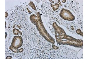 The image on the left is immunohistochemistry of paraffin-embedded Human colorectal cancer tissue using ABIN7191486(MMP24 Antibody) at dilution 1/25, on the right is treated with synthetic peptide. (MMP24 antibody)