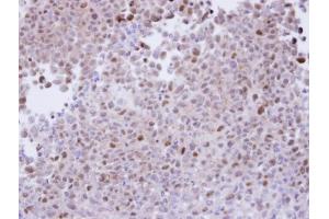 IHC-P Image Immunohistochemical analysis of paraffin-embedded CL1-5 xenograft, using proteasome alpha 7, antibody at 1:100 dilution. (PSMA7 antibody  (Center))