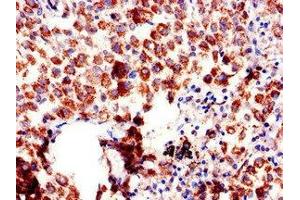 Immunohistochemistry of paraffin-embedded human lung cancer using ABIN7144520 at dilution of 1:100 (AQP6 antibody  (AA 1-30))
