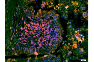 Formalin-fixed and paraffin embedded human lung carcinoma labeled with Anti-phospho-ERK1/2(Thr202 + Tyr204) Polyclonal Antibody, Unconjugated (ABIN682933) at 1:200 followed by conjugation to the secondary antibody Goat Anti-Rabbit IgG, Cy3 conjugated used at 1:200 dilution for 40 minutes at 37°C and DAPI staining (ERK1/2 antibody  (pThr202, pTyr204))