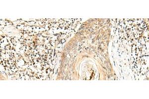 Immunohistochemistry of paraffin-embedded Human esophagus cancer tissue using POLR1E Polyclonal Antibody at dilution of 1:40(x200)