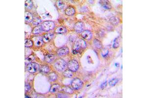 Immunohistochemical analysis of CHML staining in human lung cancer formalin fixed paraffin embedded tissue section. (CHML antibody  (Center))