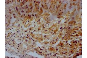 IHC image of ABIN7147174 diluted at 1:500 and staining in paraffin-embedded human glioma tissue performed on a Leica BondTM system. (CD63 antibody  (AA 103-203))