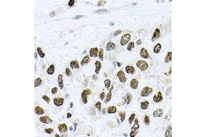 Immunohistochemical analysis of METTL3 staining in human lung cancer formalin fixed paraffin embedded tissue section. (METTL3 antibody)