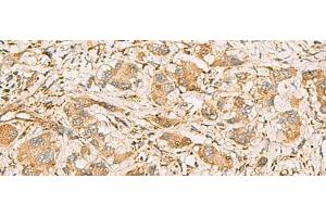 Immunohistochemistry of paraffin-embedded Human liver cancer tissue using MRPS35 Polyclonal Antibody at dilution of 1:60(x200) (MRPS35 antibody)