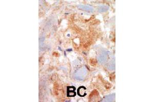 Formalin-fixed and paraffin-embedded human cancer tissue reacted with KIT polyclonal antibody  , which was peroxidase-conjugated to the secondary antibody, followed by DAB staining. (KIT antibody  (N-Term))