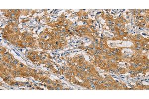 Immunohistochemistry of paraffin-embedded Human gastic cancer using ARHGEF7 Polyclonal Antibody at dilution of 1:40 (ARHGEF7 antibody)
