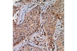 Immunohistochemical analysis of UBE2G1 staining in human breast cancer formalin fixed paraffin embedded tissue section. (UBE2G1 antibody)