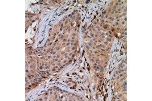 Immunohistochemical analysis of UBE2G1 staining in human breast cancer formalin fixed paraffin embedded tissue section. (UBE2G1 antibody)