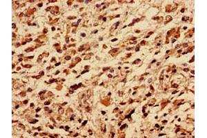 Immunocytochemistry analysis of human glioma using ABIN7142719 at dilution of 1:100 (50S Ribosomal Protein L16 (RplP) (AA 1-317) antibody)