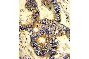 Formalin-fixed and paraffin-embedded human colon carcinoma with EPN3 Antibody (N-term), which was peroxidase-conjugated to the secondary antibody, followed by DAB staining. (EPN3 antibody  (N-Term))