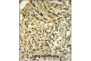 FKBP14 Antibody (N-term) (ABIN390491 and ABIN2840850) IHC analysis in formalin fixed and paraffin embedded human Lung carcinoma followed by peroxidase conjugation of the secondary antibody and DAB staining. (FKBP14 antibody  (N-Term))