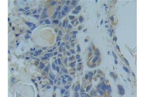 Detection of TNFR1 in Human Lung cancer Tissue using Polyclonal Antibody to Tumor Necrosis Factor Receptor 1 (TNFR1) (TNFRSF1A antibody  (AA 248-428))