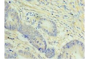 Immunohistochemistry of paraffin-embedded human colon cancer using ABIN7148434 at dilution of 1:100 (NCAPH antibody  (AA 1-250))
