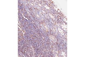 Immunohistochemical analysis of C on paraffin-embedded Human colon carcinoma tissue. (Glucuronidase beta antibody  (AA 335-362))