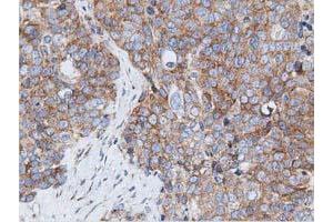Immunohistochemical staining of paraffin-embedded Adenocarcinoma of Human ovary tissue using anti-RIT2 mouse monoclonal antibody. (RIT2 antibody)