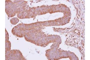 IHC-P Image Immunohistochemical analysis of paraffin-embedded human colon carcinoma, using ARHGAP4, antibody at 1:500 dilution. (ARHGAP4 antibody  (N-Term))