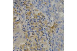 Immunohistochemistry of paraffin-embedded human lung cancer using PAK1 Antibody. (PAK1 antibody)