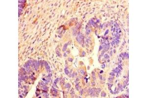 Immunohistochemistry of paraffin-embedded human ovarian cancer using ABIN7168711 at dilution of 1:100 (SCG2 antibody  (AA 31-617))